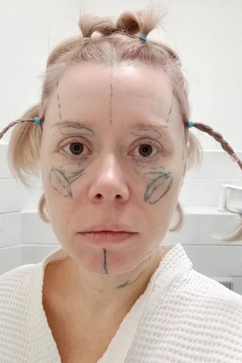 Разметка перед операцией.