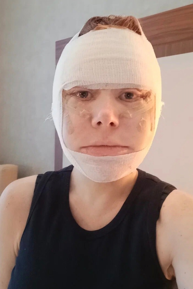 На вторые сутки начался отек лица.