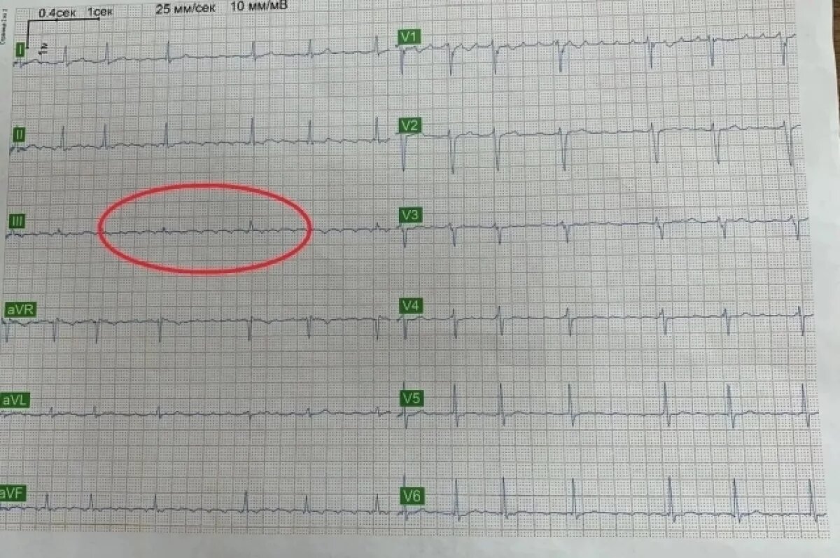    В Воронеже женщина обняла мужа и спасла его от возможной остановки сердца