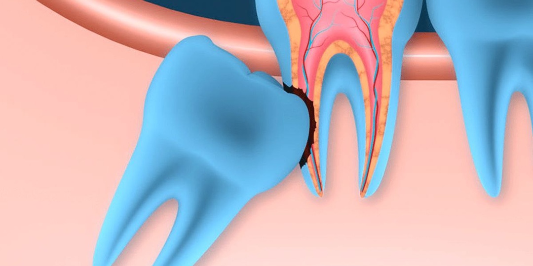 Ретинированные восьмые зубы: правда ли они такие опасные?