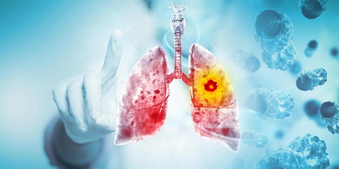 Почему этот смертельно опасный рак лёгкого почти всегда возвращается
