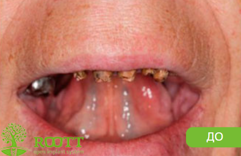 Пациент обратился с жалобами на частичное отсутствие и подвижность оставшихся зубов на верхней челюсти и полное отсутствие зубов на нижней челюсти. 