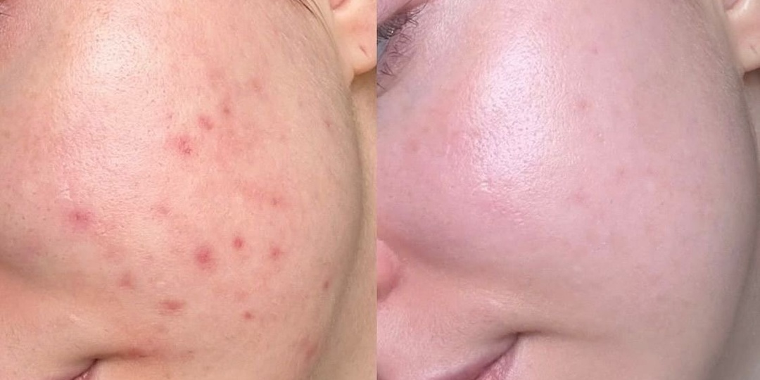 Как выстроить питание с точки зрения доказательной медицины, чтобы начать борьбу с акне