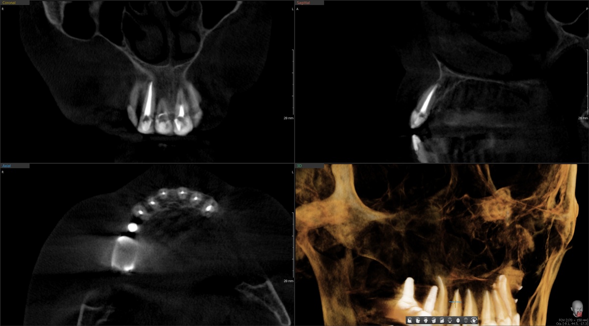 КТ - зуб 1.2 до, в канале яркая гуттаперча