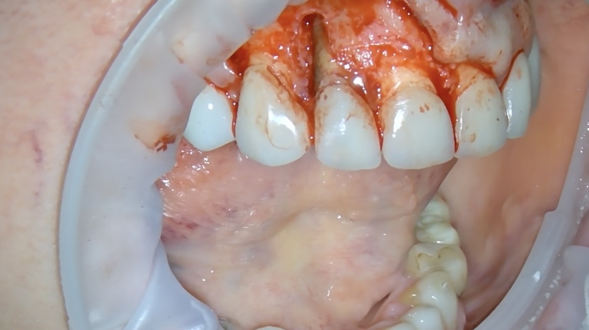 Костный дефект