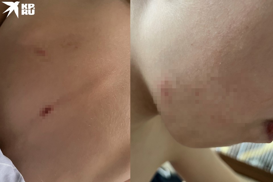 Школьник часто приходил домой в синяках. Фото: Предоставлено мамой ребенка