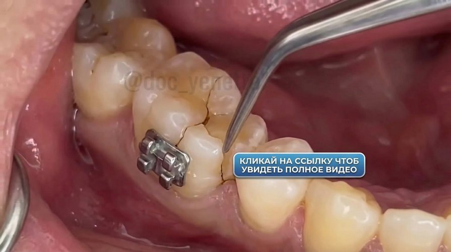Трещина на жевательном зубе с брекетом 