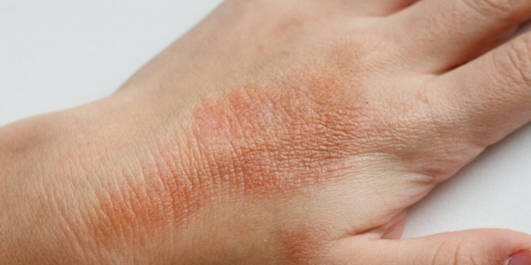 Кожа шелушится и краснеет — что важно не пропустить