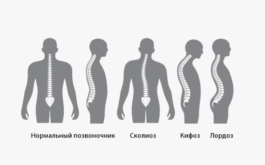 Виды нарушений осанки