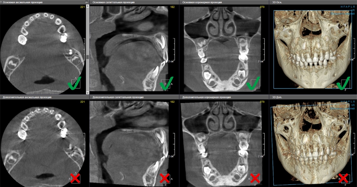 Нечеткие контуры (особенно каналов)

