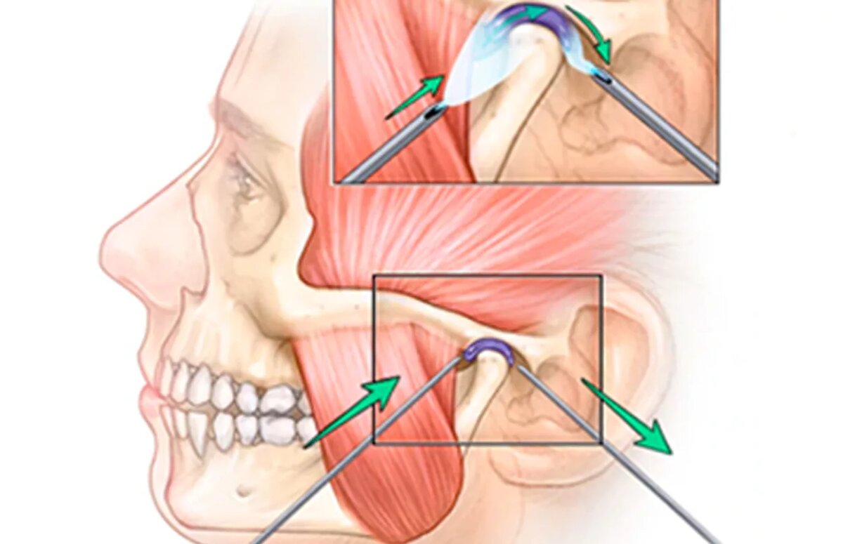 Промывание суставной щели
