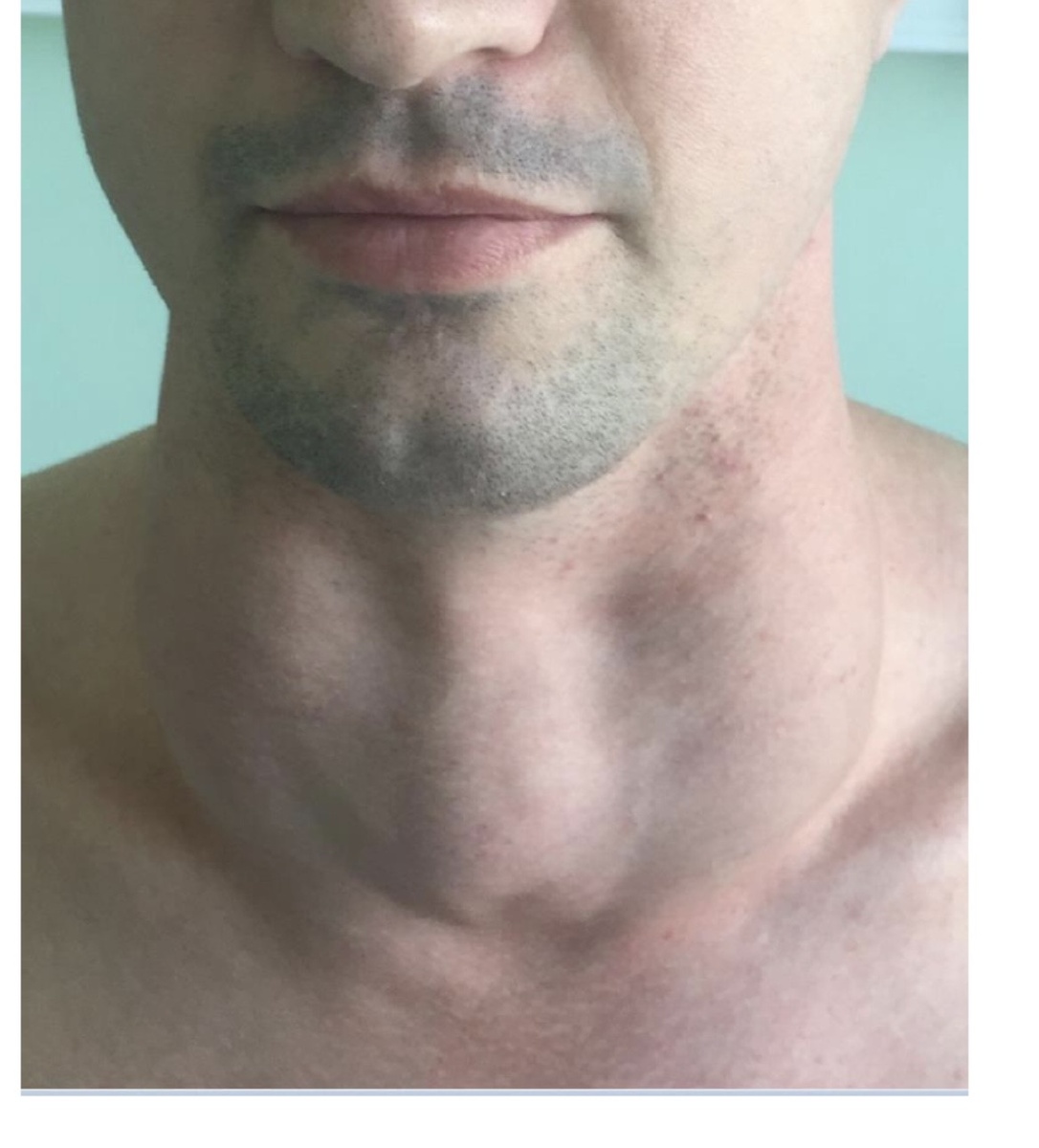 Зоб II степени