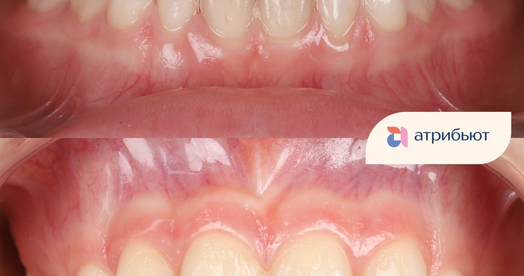 🦷 Когда зубам становится тесно — помогаем им расти правильно