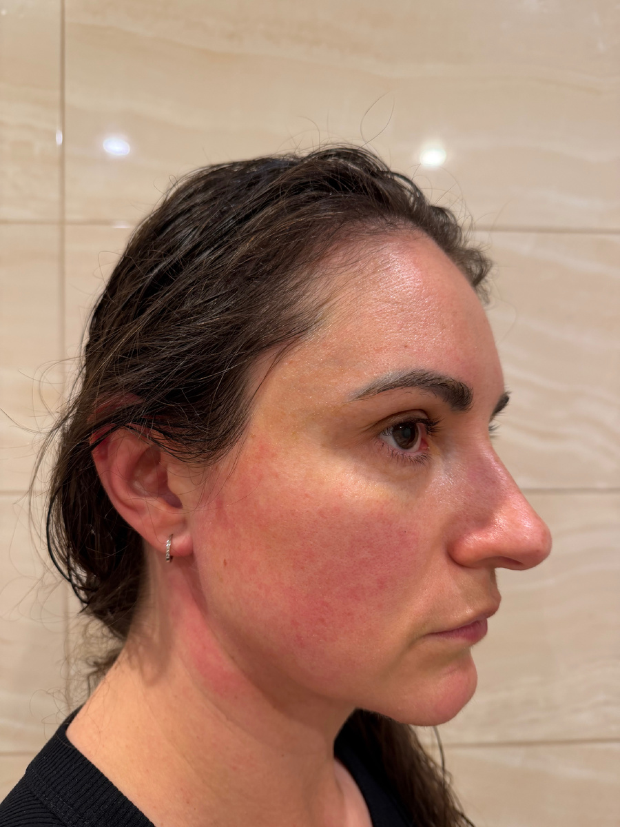 Вот так выглядит фоновое воспаление. Не острое, не «пожар», а тлеющий костёр. Краснота не уходит, просто меняет интенсивность.