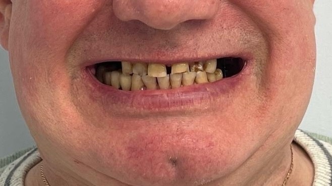 С такой ситуацией пациент обратился в клинику "Дентал Премиум"