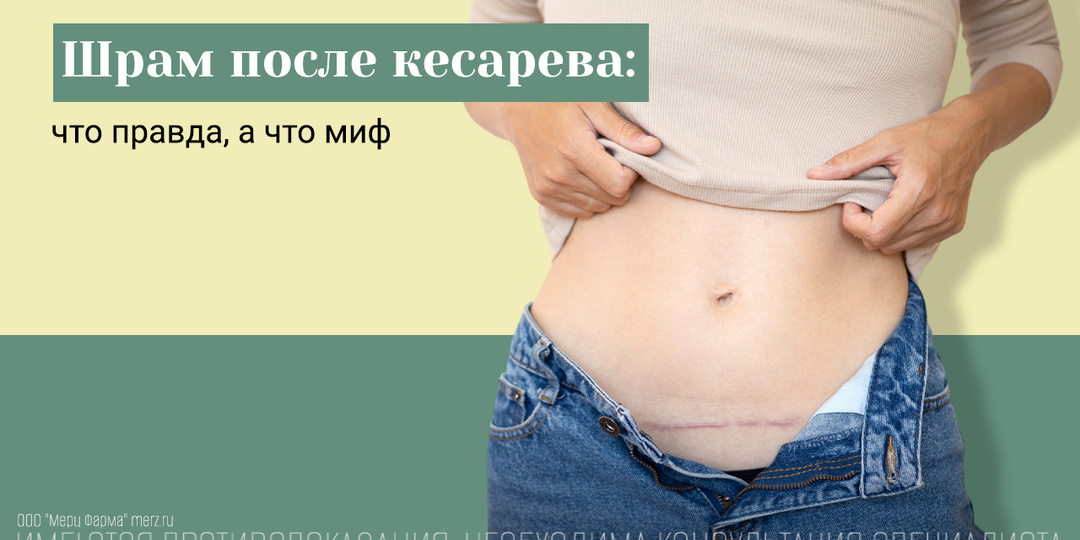 Правда и мифы о шраме от кесарева сечения