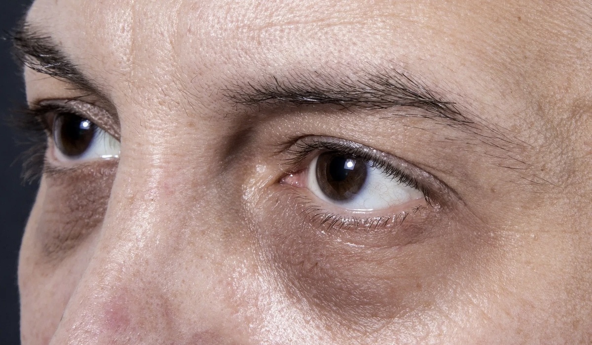 Гиперпигментация кожи вокруг глаз (симптом Еллинека) - проявление гипокортицизма.