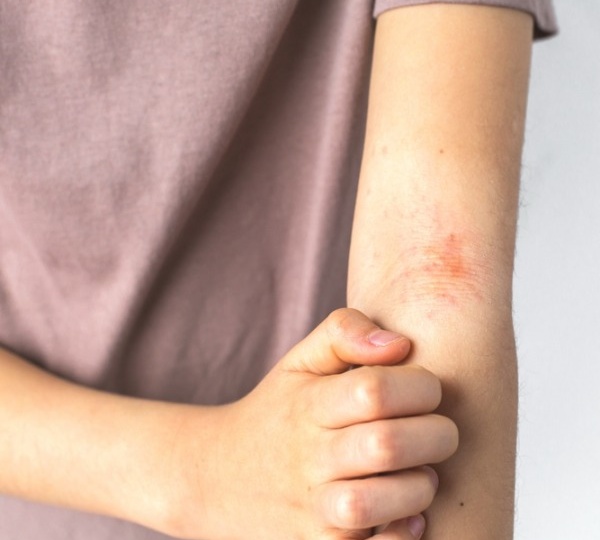 Там, где зудит и шелушится: как ухаживать за кожей при экземе в зависимости от локализации проблемы