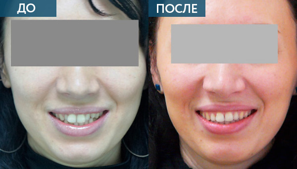 До и после ортодонтического лечения