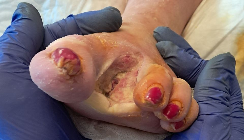 Фото 1 - оперированный пациент с СДС после выписки из стационара