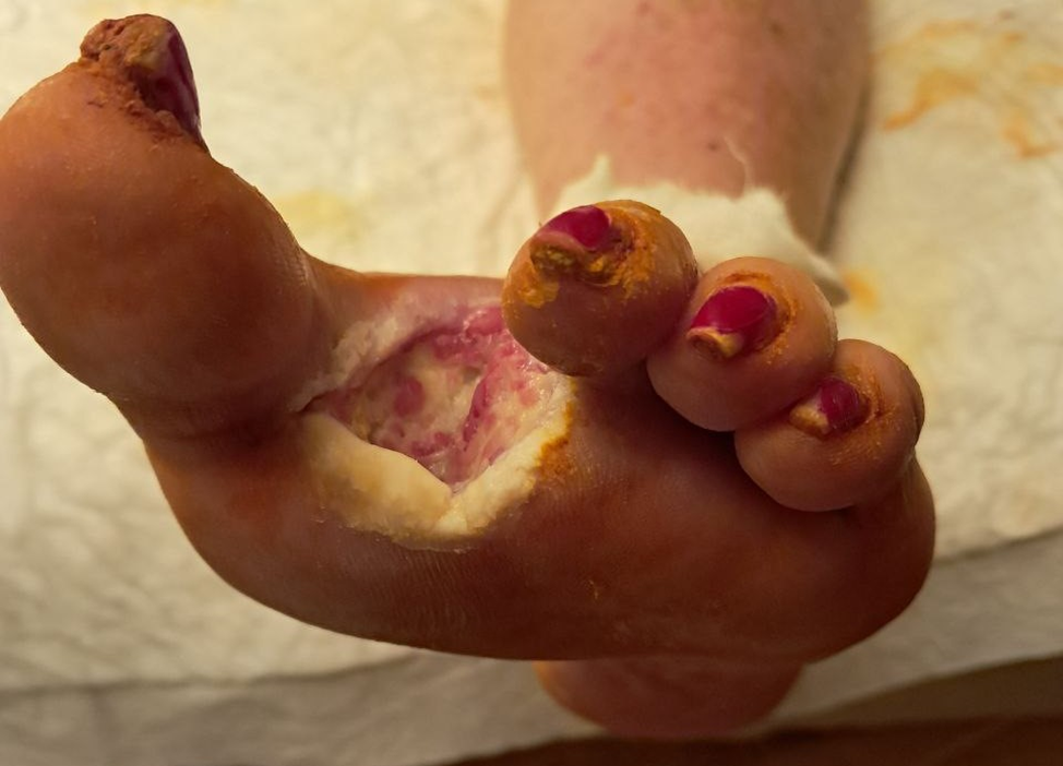 Фото 2 – рана через 1 месяц после после амбулаторного лечения