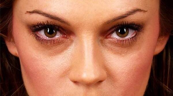 Тени прошлого: Почему появляются синяки под глазами и как с ними бороться