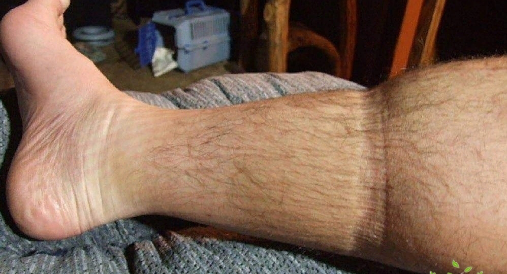 Симптомы инфаркта !