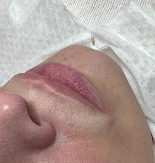 Губы после контурной пластики: как это выглядит в жизни