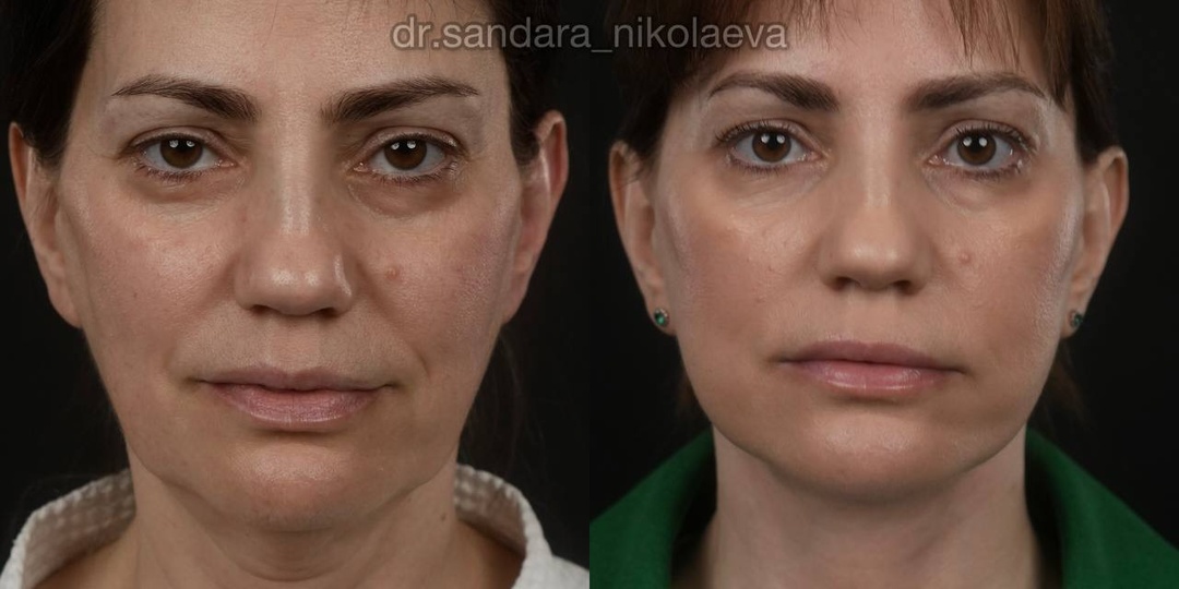 1 месяц после фейслифтинга. Пациентке 53 года