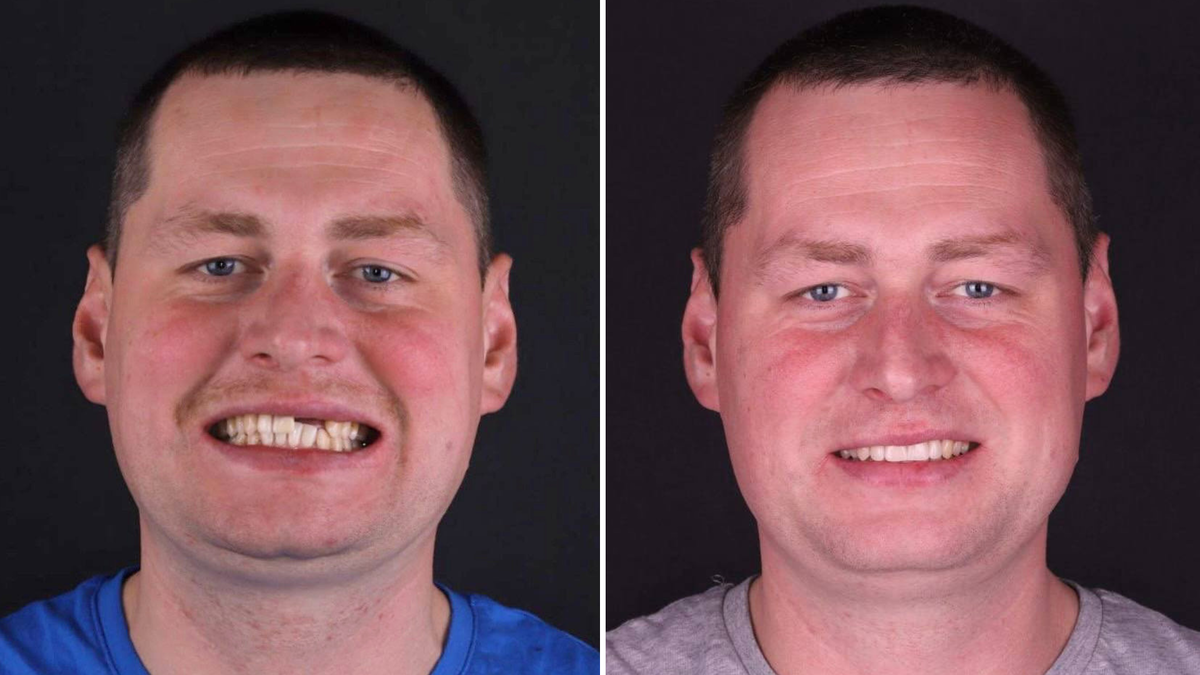 Фото нашего пациента после получения травмы и после восстановления 