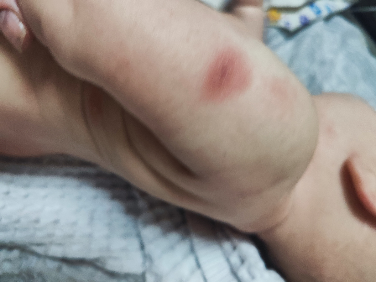 Фото места прививки БЦЖ вечером... 