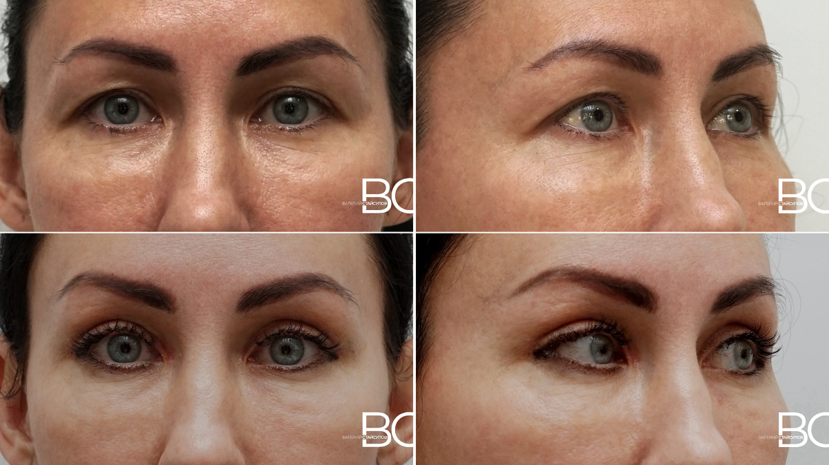 Омоложение верхней трети лица, пластический хирург Стайсупов В.Ю.