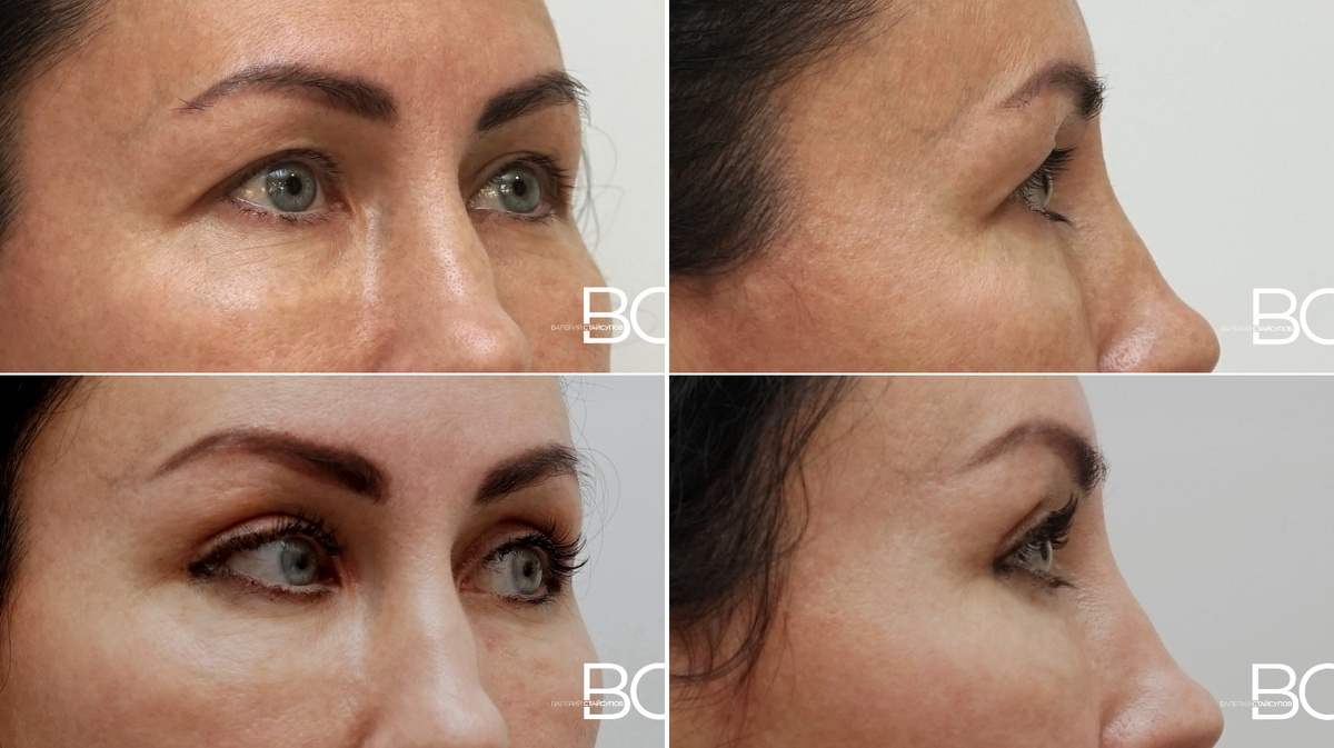 Омоложение верхней трети лица, пластический хирург Стайсупов В.Ю