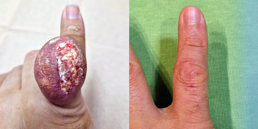 В ГКБ им. А.К.Ерамишанцева пациента избавили от огромного тофуза на мизинце