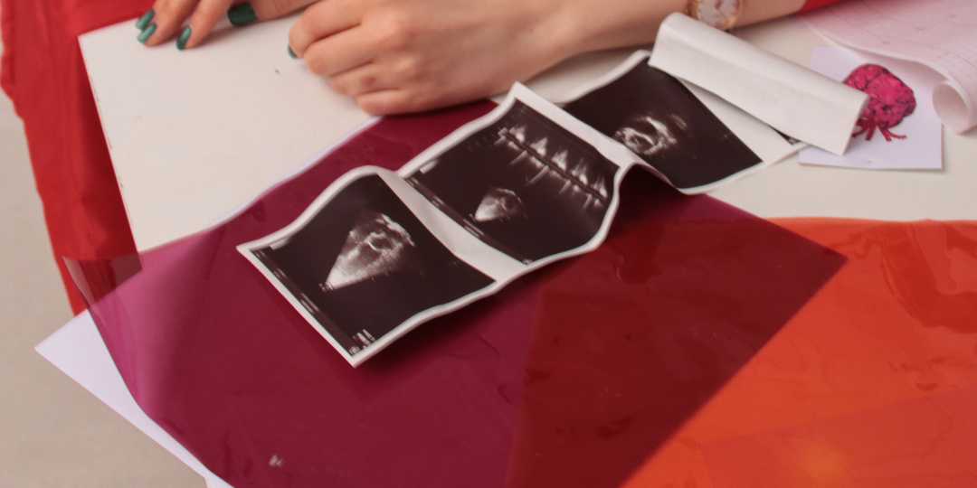 Атеросклеротические бляшки какого размера надо лечить?