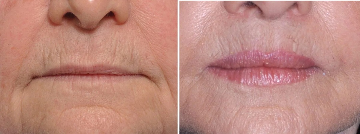 Контурная пластика губ: возвращение былого объема
