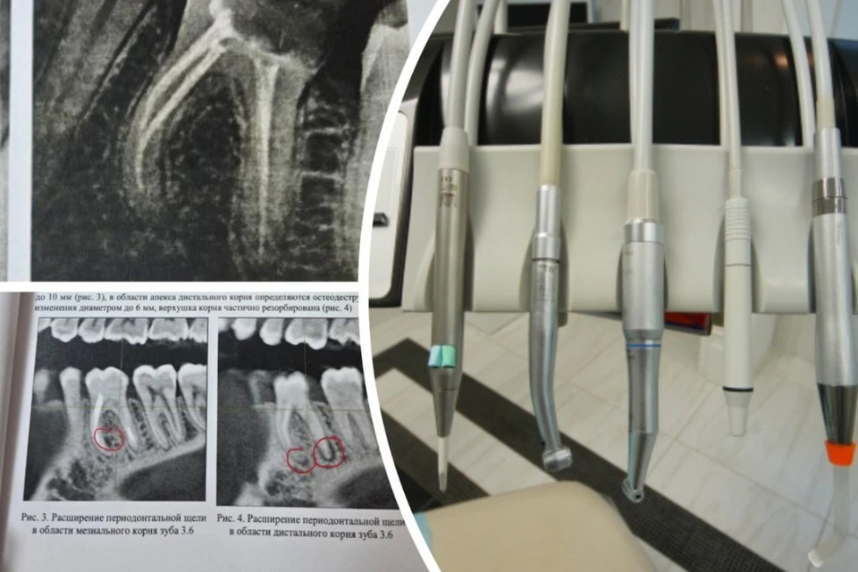 Пациентка засудила стоматологов, которые проглядели четвертый канал в зубе. Фото: Алексей БУЛАТОВ // Предоставлено пациенткой