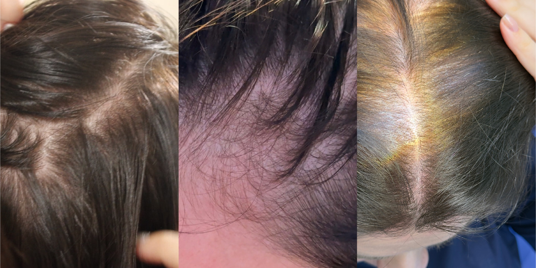 Как остановить выпадение волос?