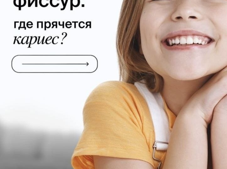 🦷ФИССУРЫ: ПОЧЕМУ ВАЖНО О НИХ ЗНАТЬ