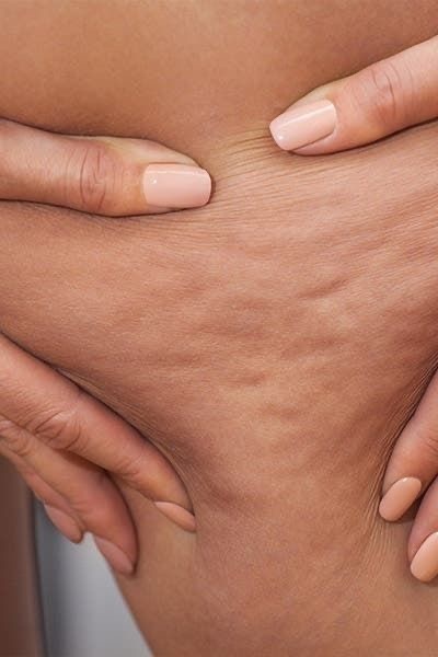 Рельеф образуется, когда жировые дольки давят на ослабленную соединительную ткань