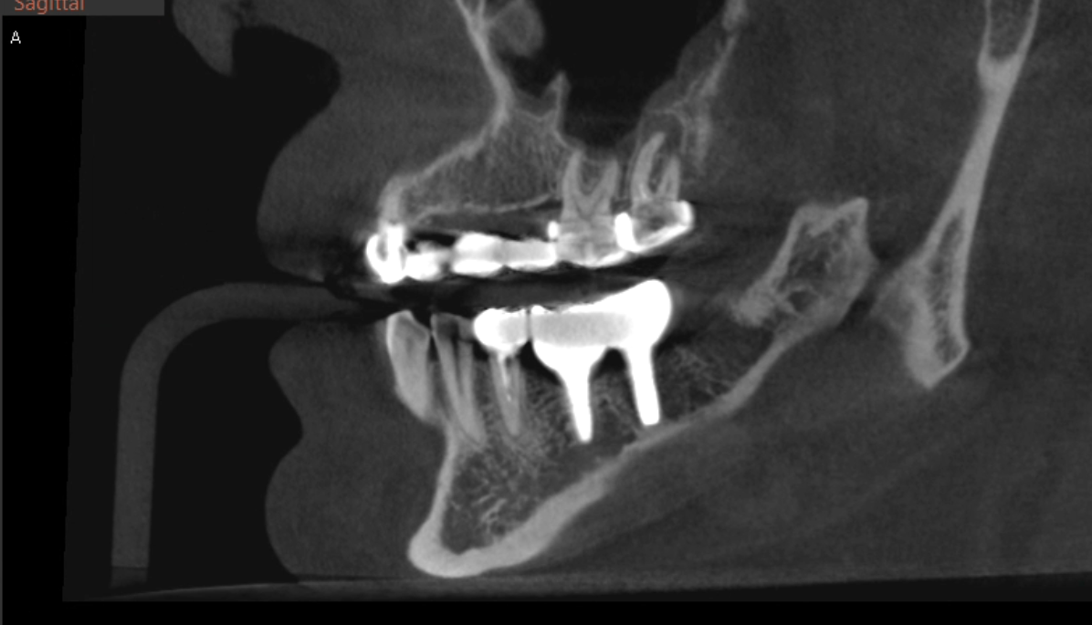 Имплантаты и коронки на них в 3 сегменте