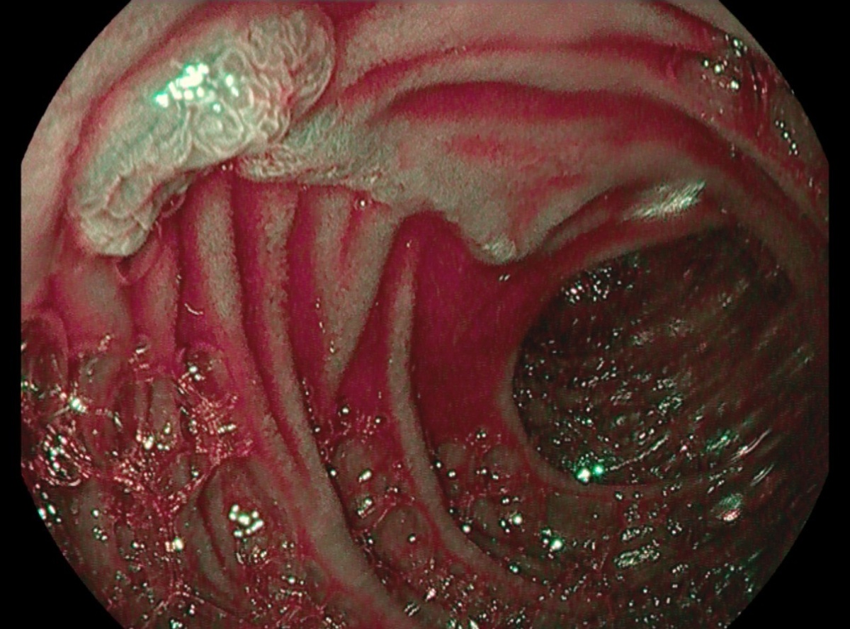 Структура рельефа слизистой при хромэндоскопии