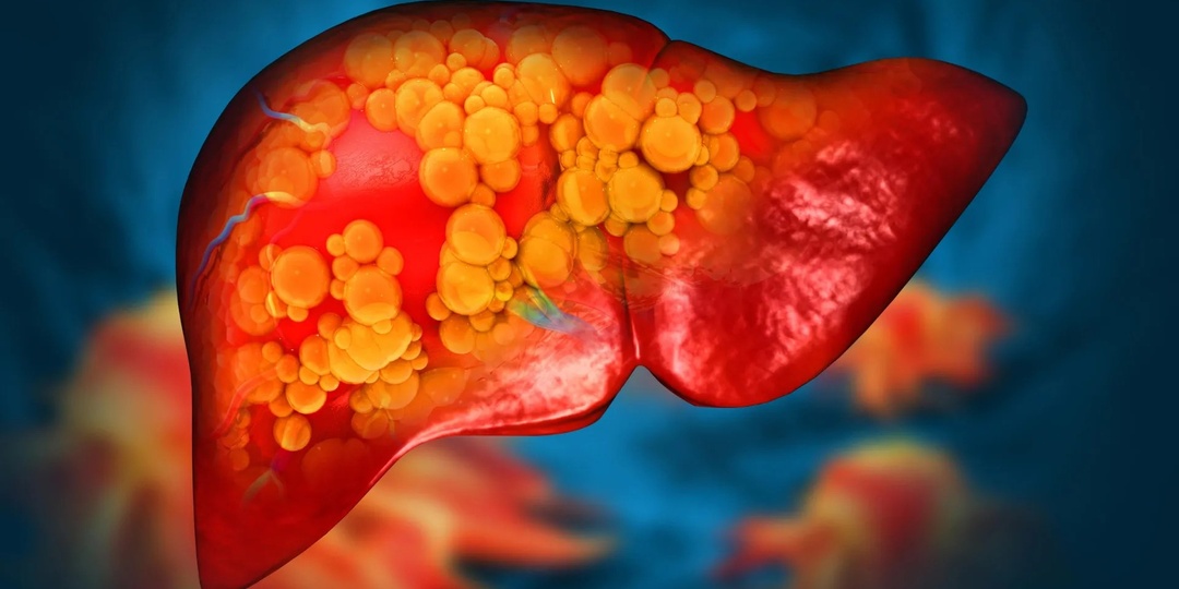 Даже редкие эпизоды запойного употребления алкоголя могут почти втрое повышать риск фиброза печени