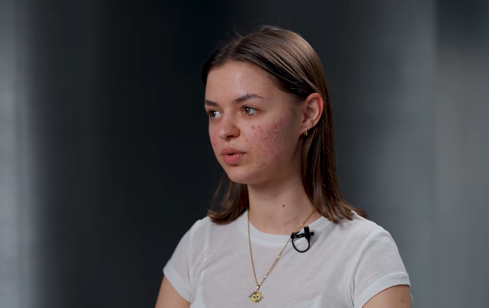 Состояние кожи «ДО» у героини шоу «Намажьте это немедленно»