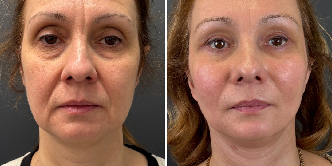 Фейслифтинг: результат 1 месяц после операции