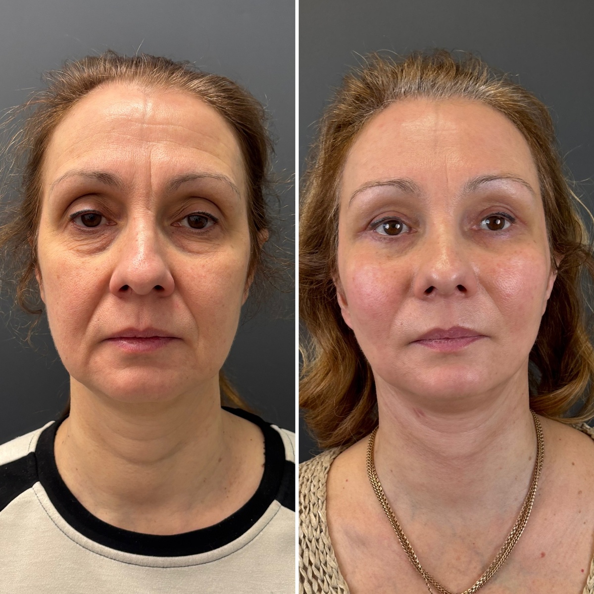 Комплексное омоложение лица- фейслифтинг: слева- до, справа- после на сроке 1 месяц после операции. Хирург к.м.н. Остринская Т.В. 