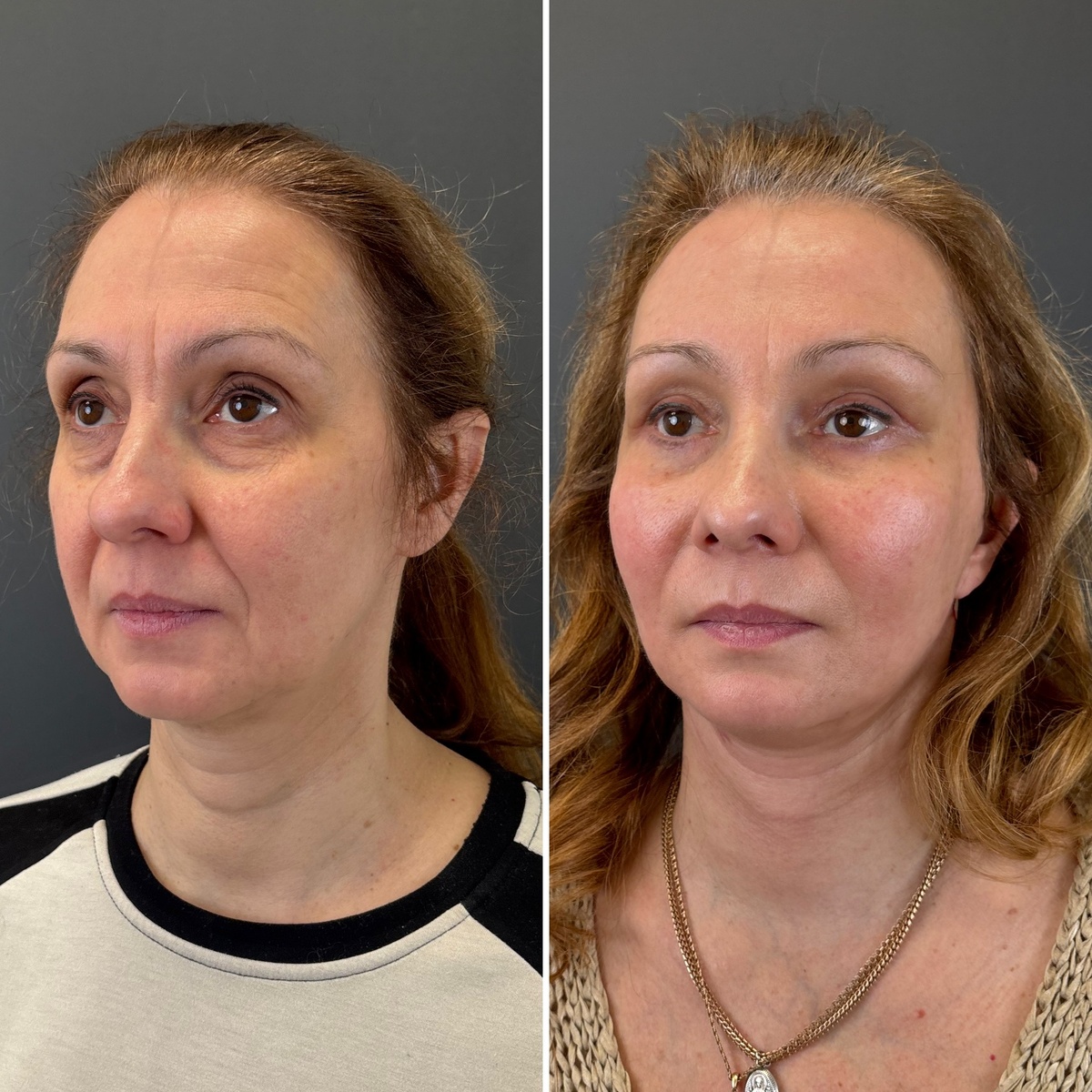 Комплексное омоложение лица- фейслифтинг: слева- до, справа- после на сроке 1 месяц после операции. Хирург к.м.н. Остринская Т.В. 
