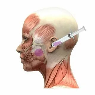 Инъекции ботулотоксина в область жевательных мышц