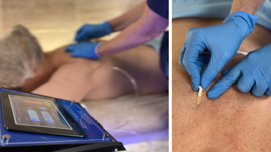 Карбокситерапия — избавляемся от боли по новому