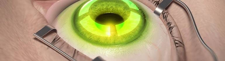 Кератоконус, как лечить?